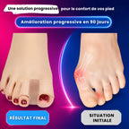 Correcteurs d’Orteils Anti-oignons